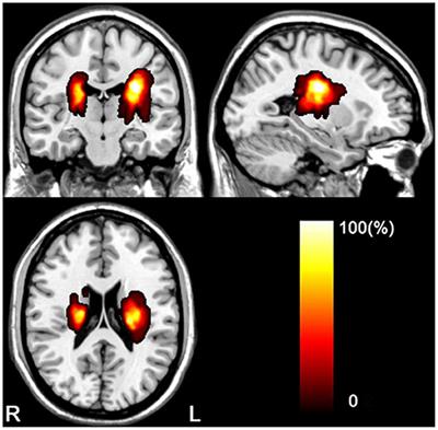 Dynamic Relationship Between Interhemispheric Functional Connectivity and Corticospinal Tract Changing Pattern After Subcortical Stroke